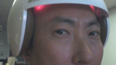 탈모치료